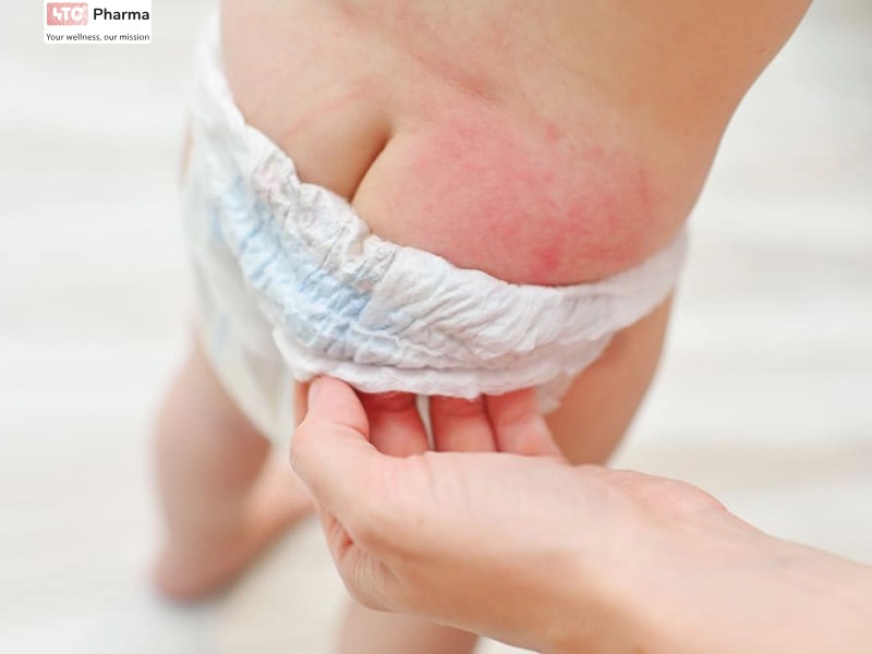 Vết hăm tã trên mông trẻ em