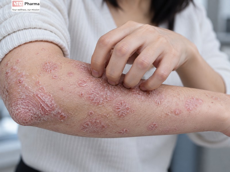 Hình ảnh vảy nến ở tay gây ngứa