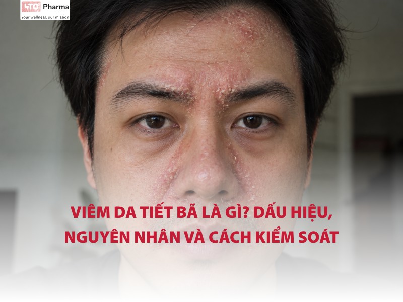 Viêm da tiết bã là gì? Dấu hiệu, nguyên nhân và cách kiểm soát